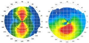 topografia de córnea de um paciente com ceratocone