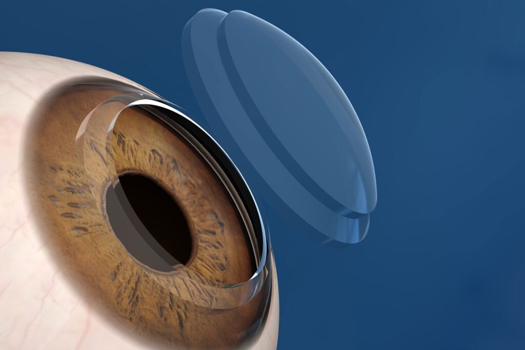 transplante de cornea