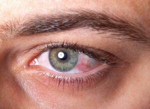 Substâncias químicas em contato com os olhos: saiba o que fazer.