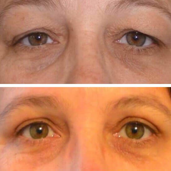 blefaroplastia superior