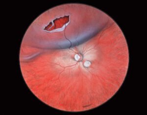 Descolamento de Retina