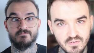 antes e depois de cirurgia de estrabismo