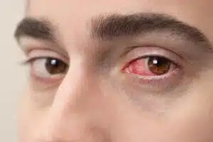 herpes