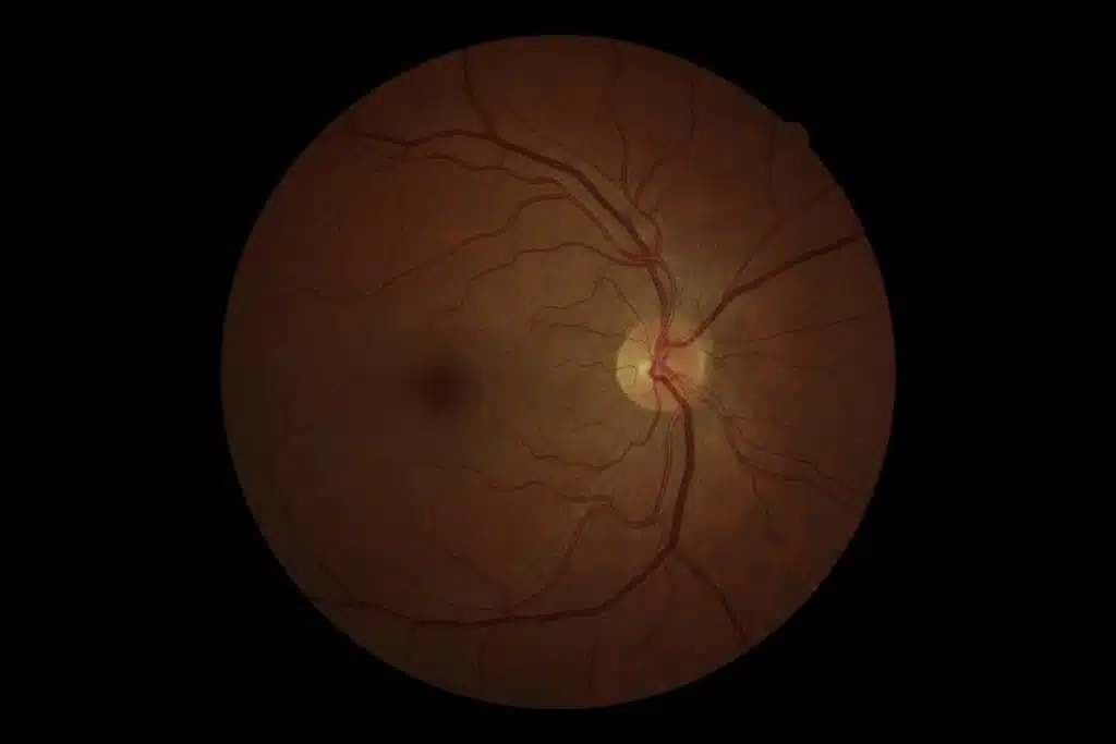 Mapeamento de retina