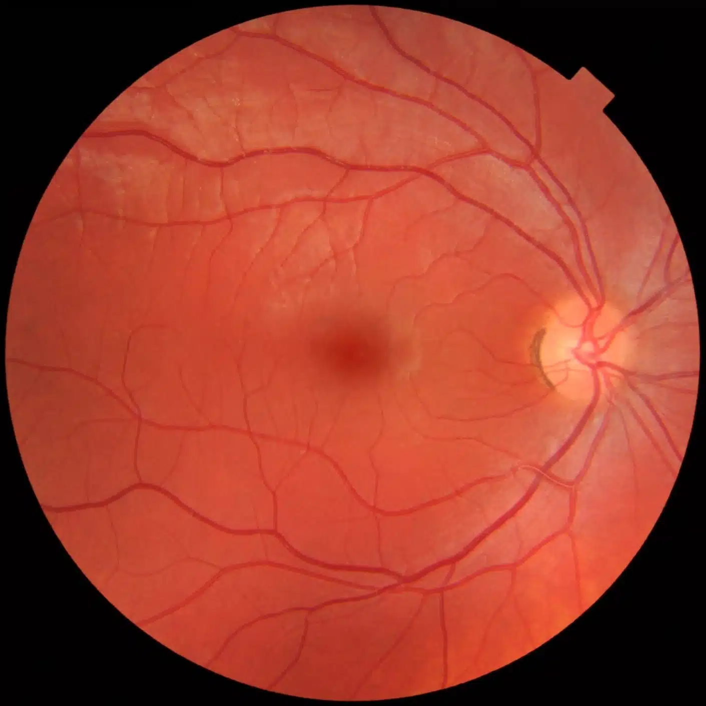 Retinografia
