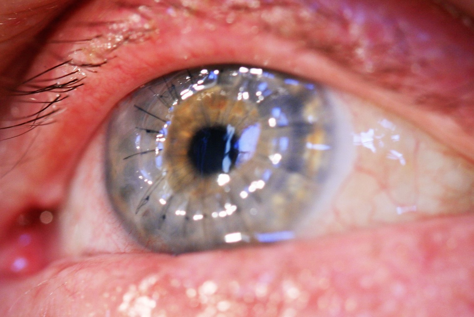 Transplante Lamelar Anterior (DALK)