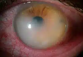 opacidade de cornea