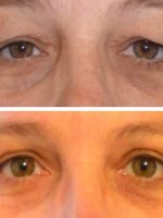 blefaroplastia superior