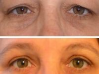 blefaroplastia superior