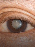 Cirurgia de Catarata