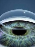 Transplante de Córnea